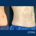 Video Testimonials: Learn About Cool Sculpting Services from Real Patients
