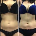 Comparing Cool Sculpting and Liposuction: Which is the Better Option?