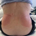 Understanding the Common Side Effects of Cool Sculpting