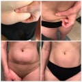 Real Life Success Stories: How Cool Sculpting Can Transform Your Body
