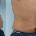 Maintaining Results After Cool Sculpting: Tips and Advice