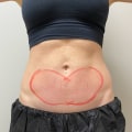 Is Cool Sculpting Safe for All Skin Types?