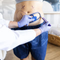 Achieving Desired Results with Cool Sculpting Alone