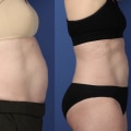 Realistic Expectations for Your Body Transformation with Cool Sculpting