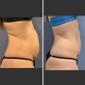 Exploring the Long-Term Results of Cool Sculpting: Real Life Success Stories