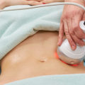 The Advantages of Non-Surgical Body Contouring