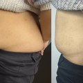 Understanding the Likelihood of Fat Regain After Cool Sculpting