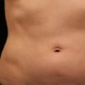 The Do's and Don'ts After Treatment for Cool Sculpting