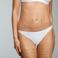 Choosing the Right Body Contouring Technique for Your Desired Results