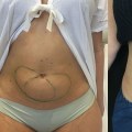 Where to Find Written Reviews of Cool Sculpting