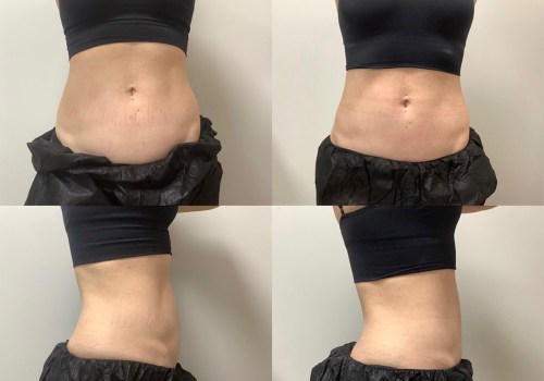 Will My Body Look Natural After Cool Sculpting?