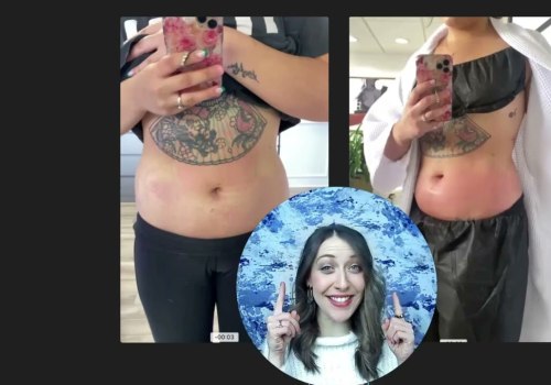 Recovery Time After Cool Sculpting: What You Need to Know
