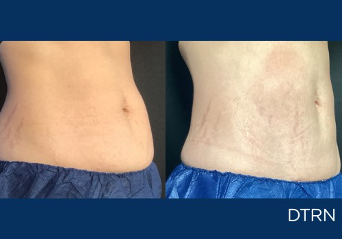 Video Testimonials: Learn About Cool Sculpting Services from Real Patients