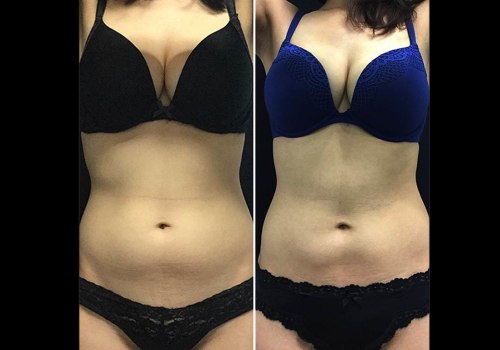 Comparing Cool Sculpting and Liposuction: Which is the Better Option?