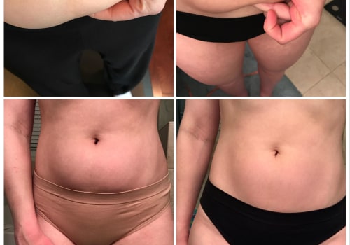 Real Life Success Stories: How Cool Sculpting Can Transform Your Body