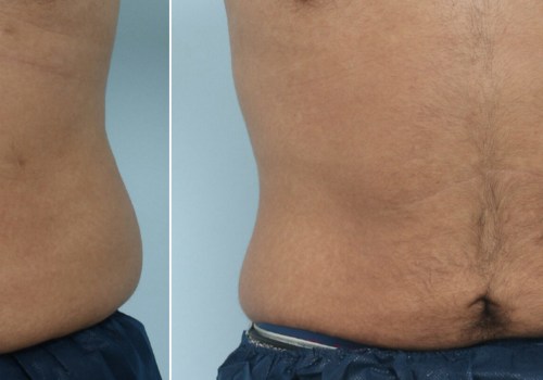 Maintaining Results After Cool Sculpting: Tips and Advice