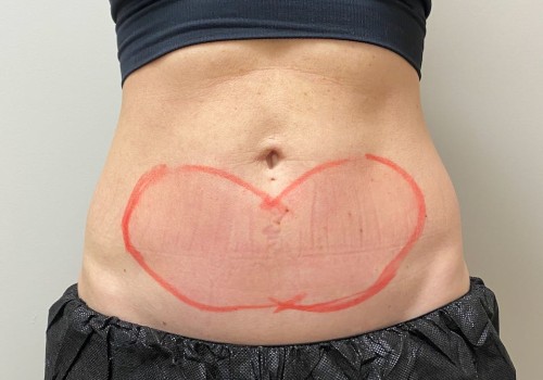 Is Cool Sculpting Safe for All Skin Types?