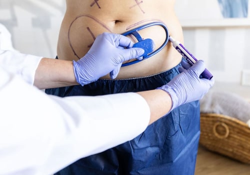 Achieving Desired Results with Cool Sculpting Alone
