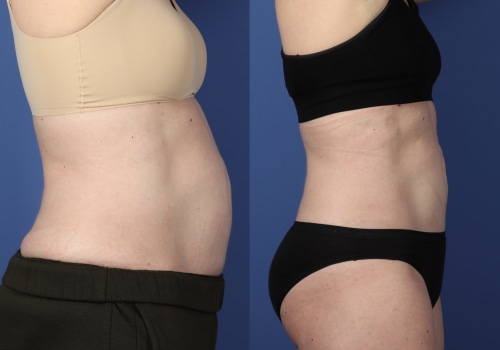 Realistic Expectations for Your Body Transformation with Cool Sculpting