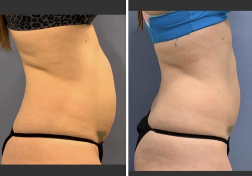 Exploring the Long-Term Results of Cool Sculpting: Real Life Success Stories