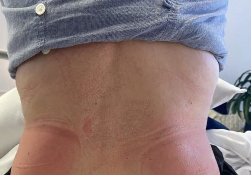 Is Cool Sculpting Safe? What You Need to Know