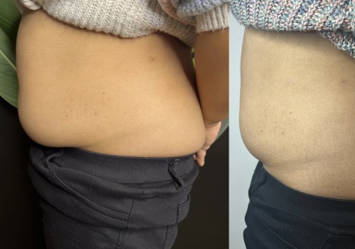 Understanding the Likelihood of Fat Regain After Cool Sculpting