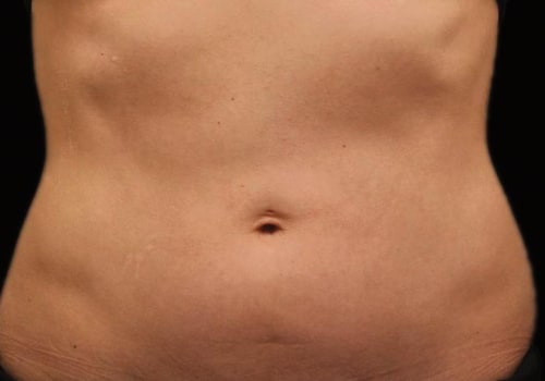 The Do's and Don'ts After Treatment for Cool Sculpting