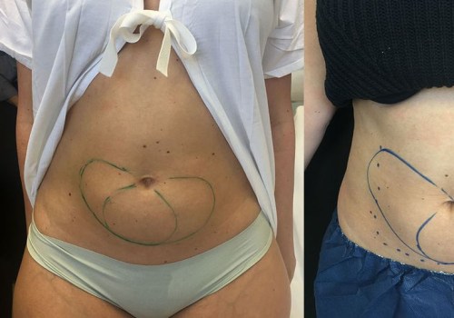 Where to Find Written Reviews of Cool Sculpting